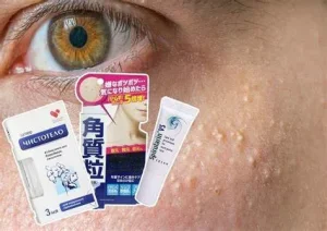 Kem Trị Mụn Hiệu Quả Nhất Hiện Nay? "Điểm Mặt" 7 "Chiến Binh" Đánh Bay Mụn Tận Gốc