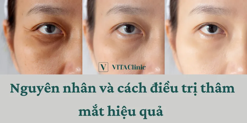 "Điểm Mặt" Những Nguyên Nhân Chính Gây Ra Quầng Thâm Mắt