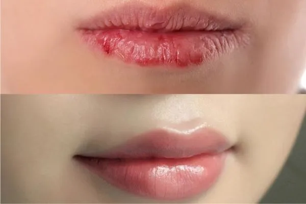 Tại Sao Đôi Môi Dễ Bị Khô?